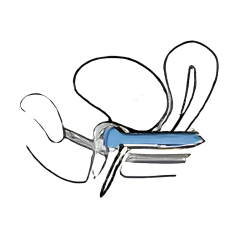 Dr Arabin - Pessaire urétral avec bouton DR ARABIN - 3